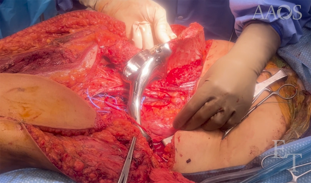 Fig 1. This AAOS Orthopaedic Video Theater presentation features Tae Won Benjamin Kim, MD, FAAOS, and colleagues as they demonstrate a case involving hemipelvectomy and custom pelvic reconstruction for a grade II periacetabular chondrosarcoma.