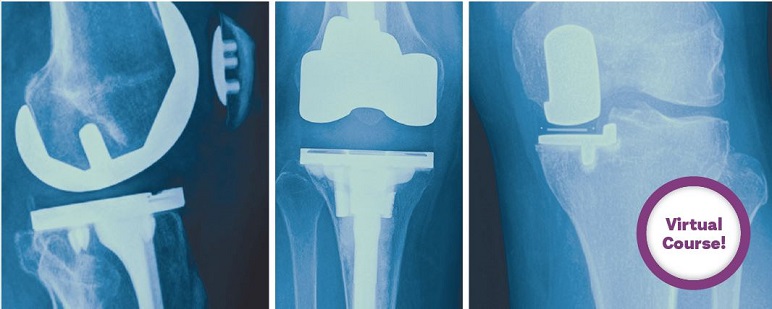 Innovative Techniques In Total Knee Arthroplasty - American Academy Of ...