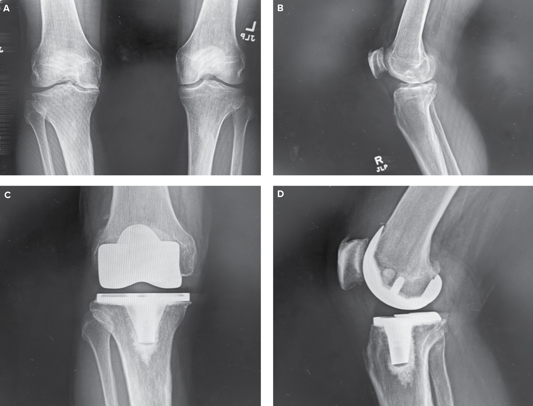 Board Approves CPGs For Surgical Management Of Knee Osteoarthritis And ...