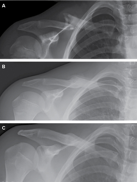 Board Approves CPGs for Surgical Management of Knee Osteoarthritis and ...