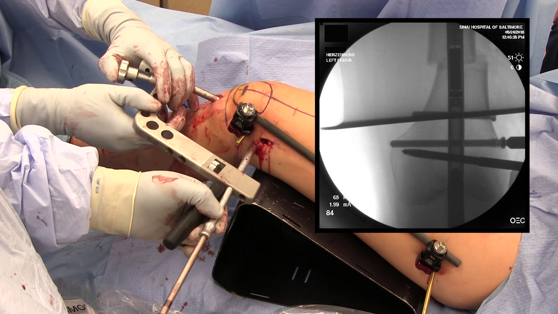 Locked Lateral Plating Versus Retrograde Nailing for Distal Femur  Fractures: A Multicenter Randomized Trial