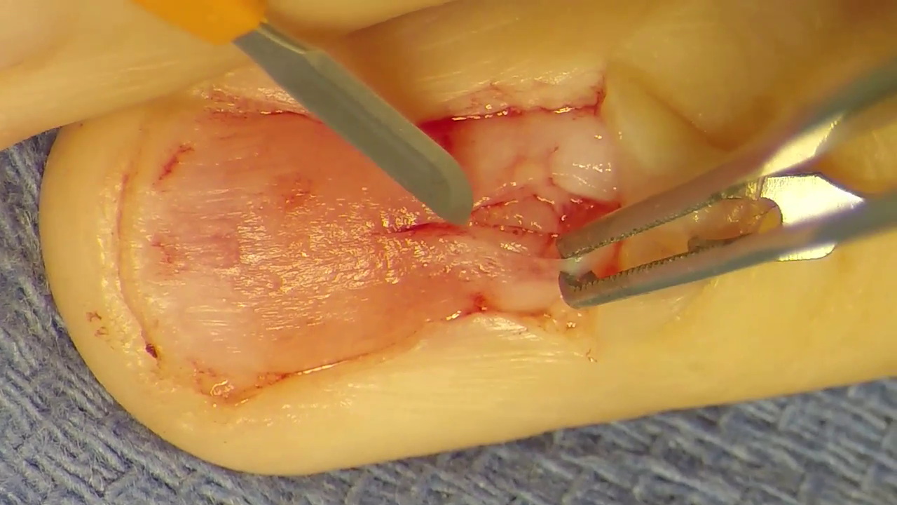 Excision of Glomus Tumor Using the Nail-sparing Approach - NYU Langone  Orthopedic Digital Library